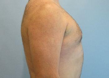 Aspira Plastic Surgery & Med Spa: Dr. Venkata Erella gynecomastia after — Austin, TX