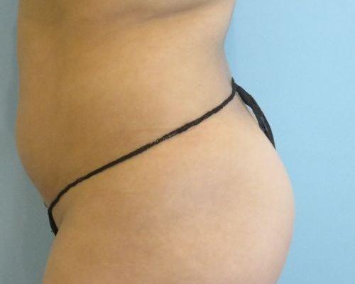 Liposuction before at Aspira Plastic Surgery & Med Spa: Dr. Venkata Erella in Austin, TX