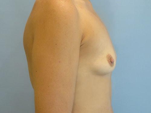 Fat Transfer Breast Augmentation before at Aspira Plastic Surgery & Med Spa: Dr. Venkata Erella in Austin, TX