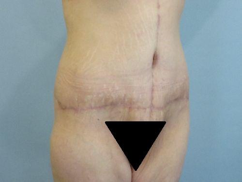 Tummy Tuck result at Aspira Plastic Surgery & Med Spa: Dr. Venkata Erella in Austin, TX