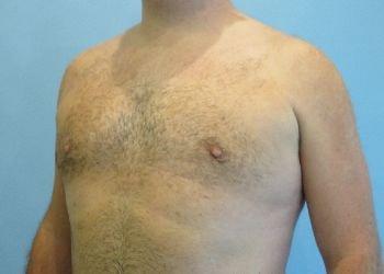 Aspira Plastic Surgery & Med Spa: Dr. Venkata Erella gynecomastia after — Austin, TX