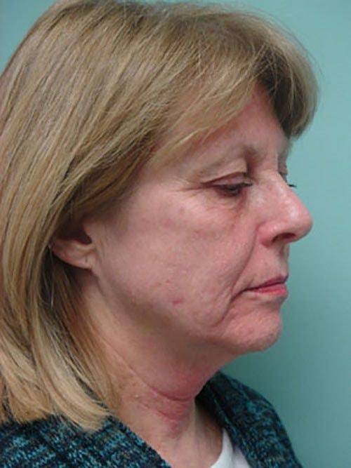 Facelift before at Aspira Plastic Surgery & Med Spa: Dr. Venkata Erella in Austin, TX