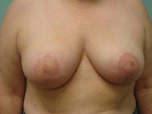 Aspira Plastic Surgery & Med Spa: Dr. Venkata Erella breast reduction result — Austin, TX