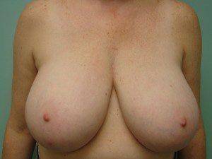 Aspira Plastic Surgery & Med Spa: Dr. Venkata Erella breast lift result — Austin, TX