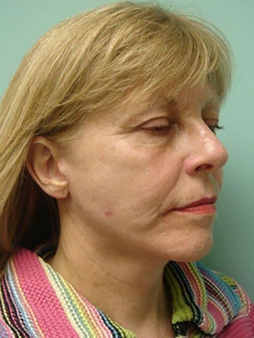 Aspira Plastic Surgery & Med Spa: Dr. Venkata Erella facelift after — Austin, TX