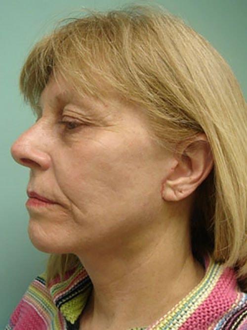 Facelift after at Aspira Plastic Surgery & Med Spa: Dr. Venkata Erella in Austin, TX