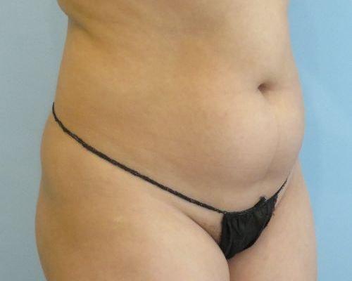 Liposuction before at Aspira Plastic Surgery & Med Spa: Dr. Venkata Erella in Austin, TX
