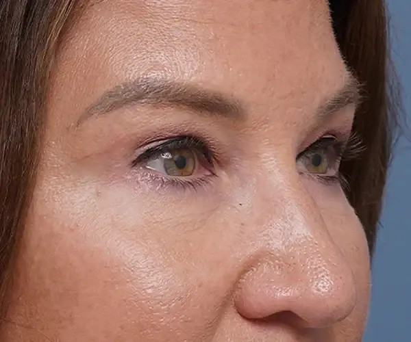 Justin Bellamy, MD brow lift after — Palm Beach Gardens, FL
