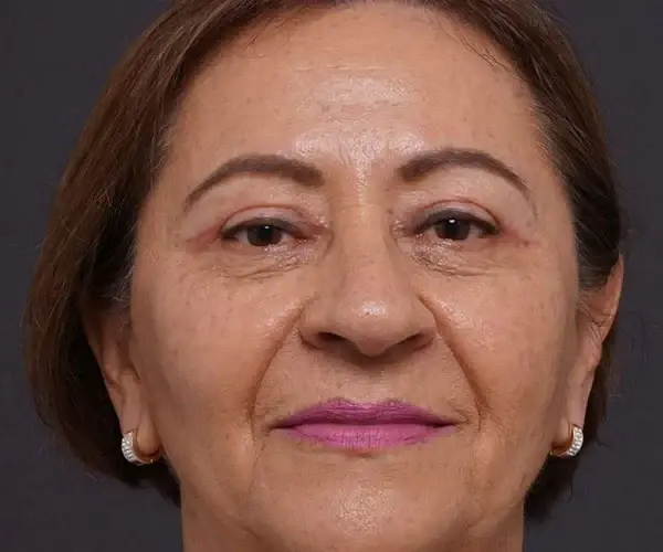 Justin Bellamy, MD brow lift after — Palm Beach Gardens, FL