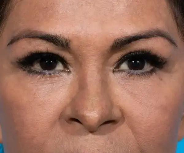 Justin Bellamy, MD brow lift after — Palm Beach Gardens, FL