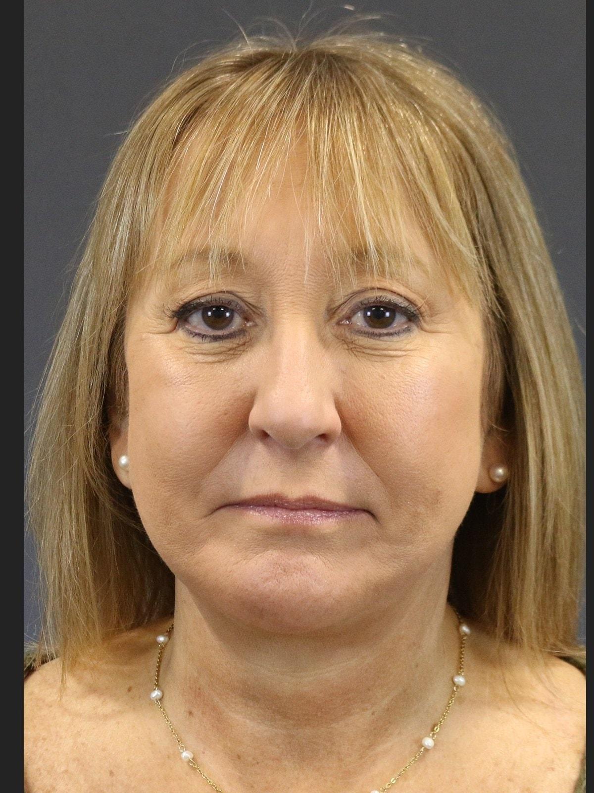 FaceLove Facial Plastic Surgery facelift after — Oakbrook Terrace, IL