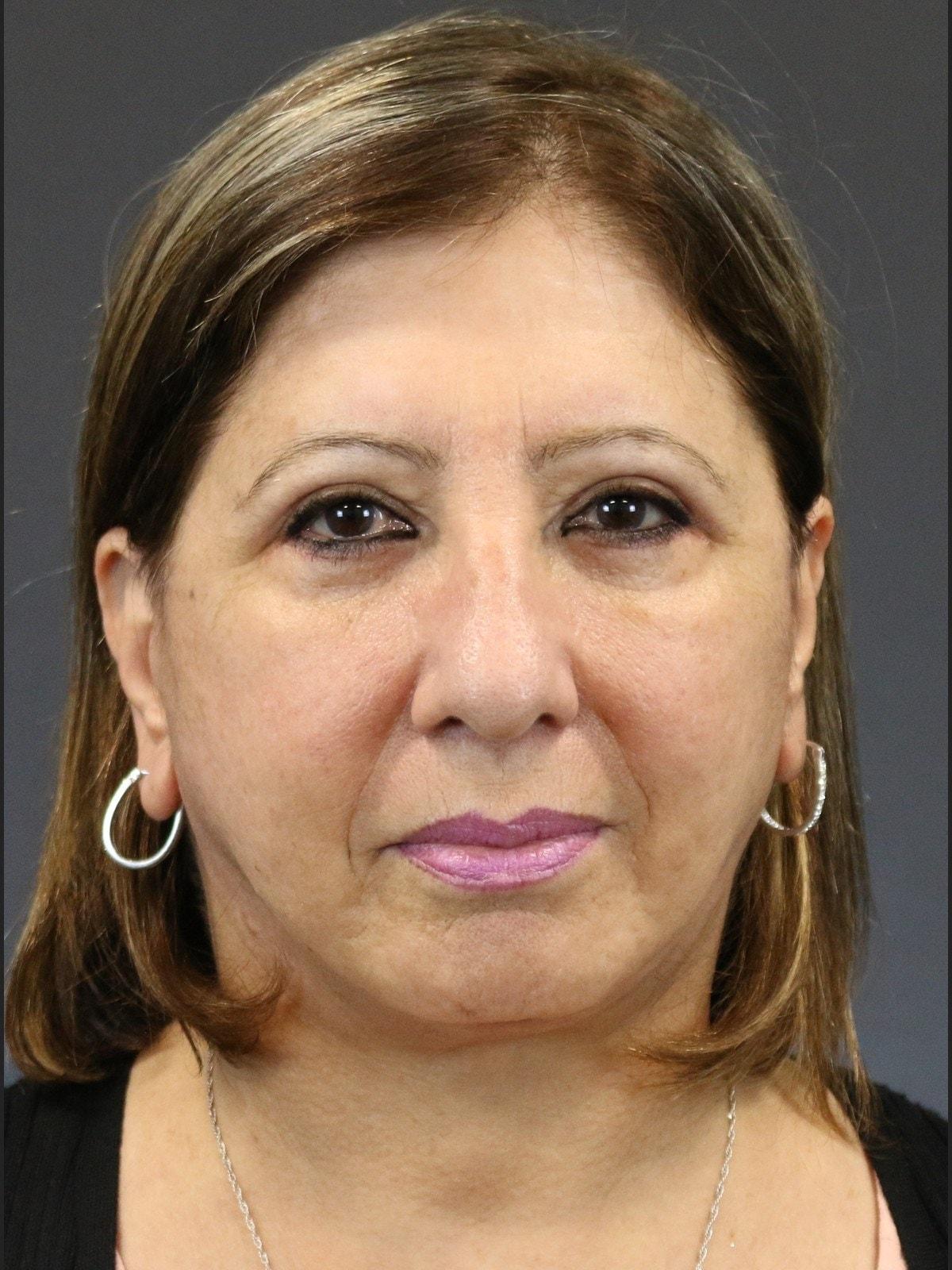 FaceLove Facial Plastic Surgery eyelid lift after — Oakbrook Terrace, IL