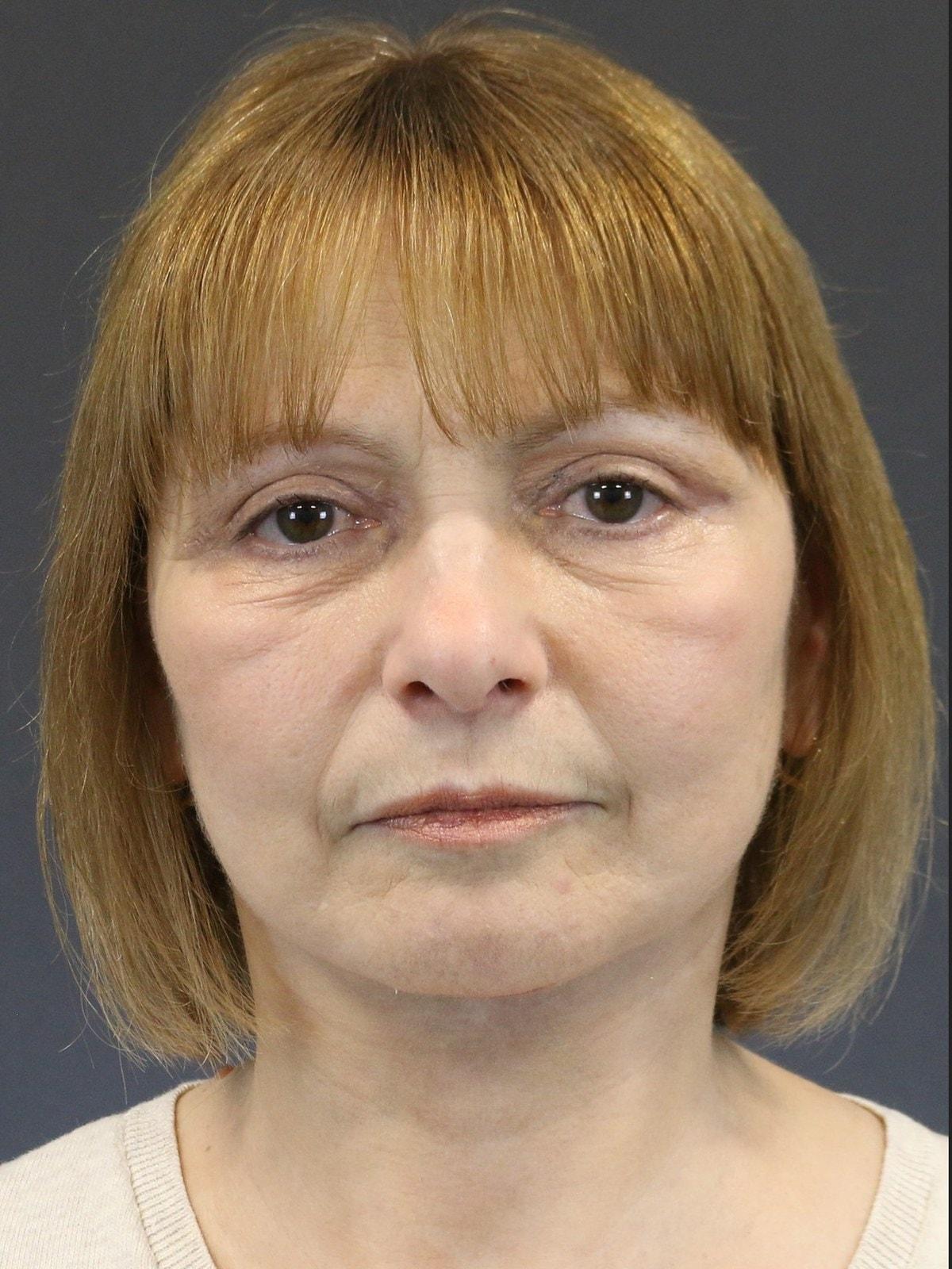 FaceLove Facial Plastic Surgery eyelid lift after — Oakbrook Terrace, IL