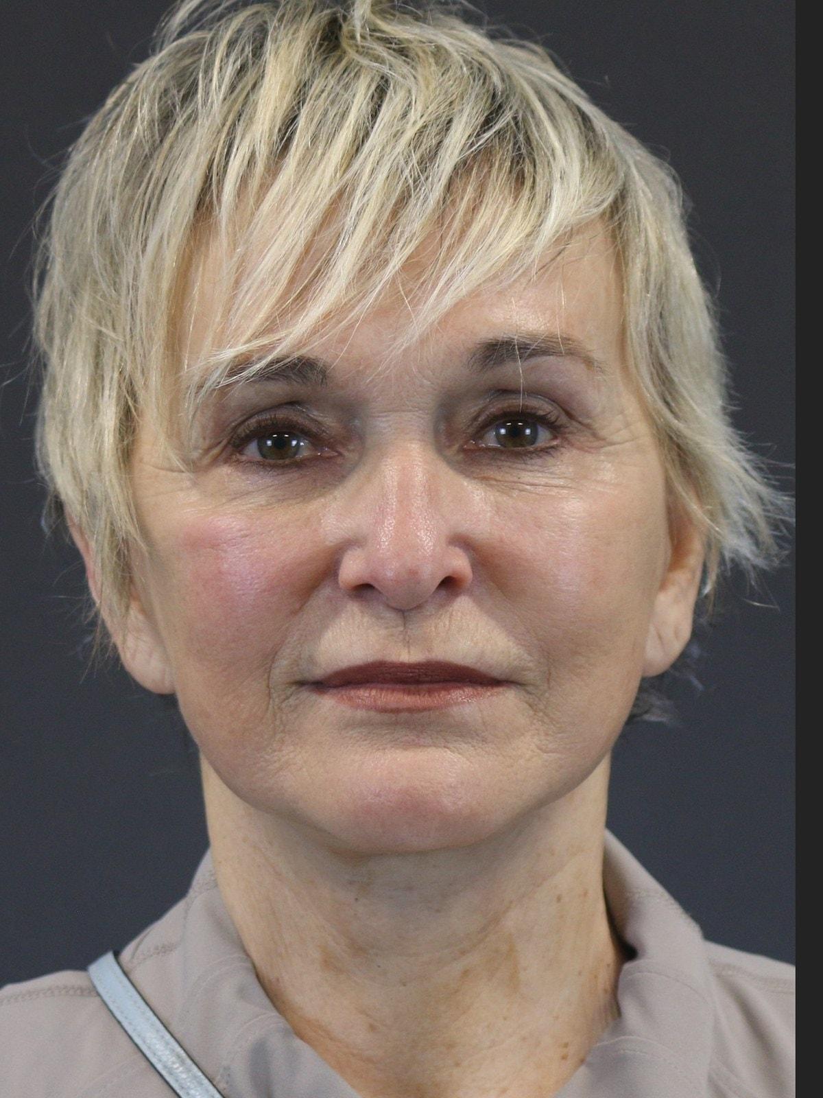 FaceLove Facial Plastic Surgery facelift after — Oakbrook Terrace, IL