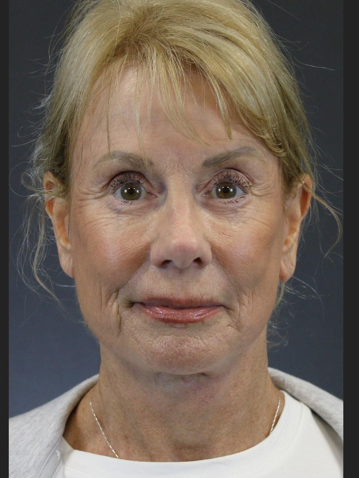 FaceLove Facial Plastic Surgery facelift after — Oakbrook Terrace, IL