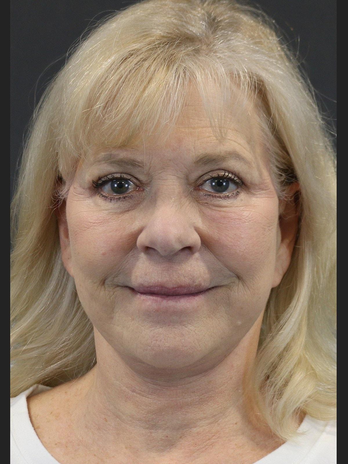 FaceLove Facial Plastic Surgery eyelid lift after — Oakbrook Terrace, IL
