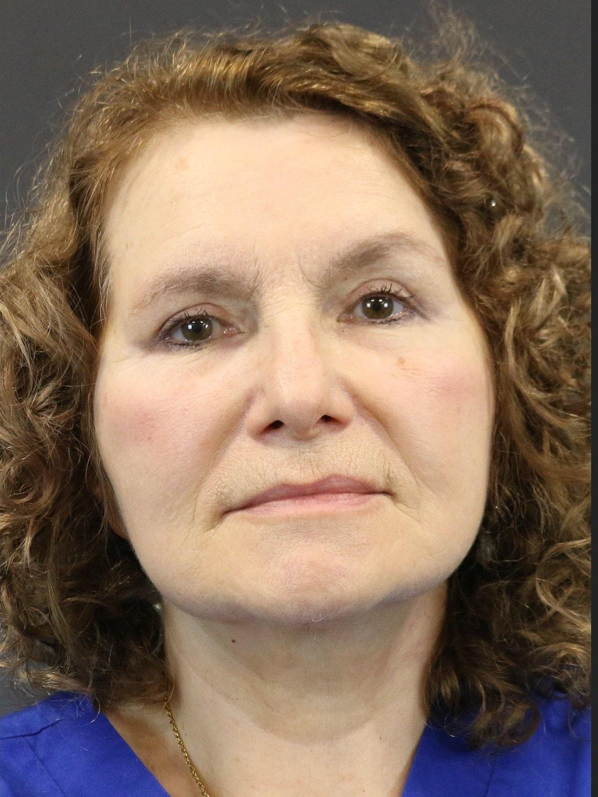 FaceLove Facial Plastic Surgery facelift after — Oakbrook Terrace, IL