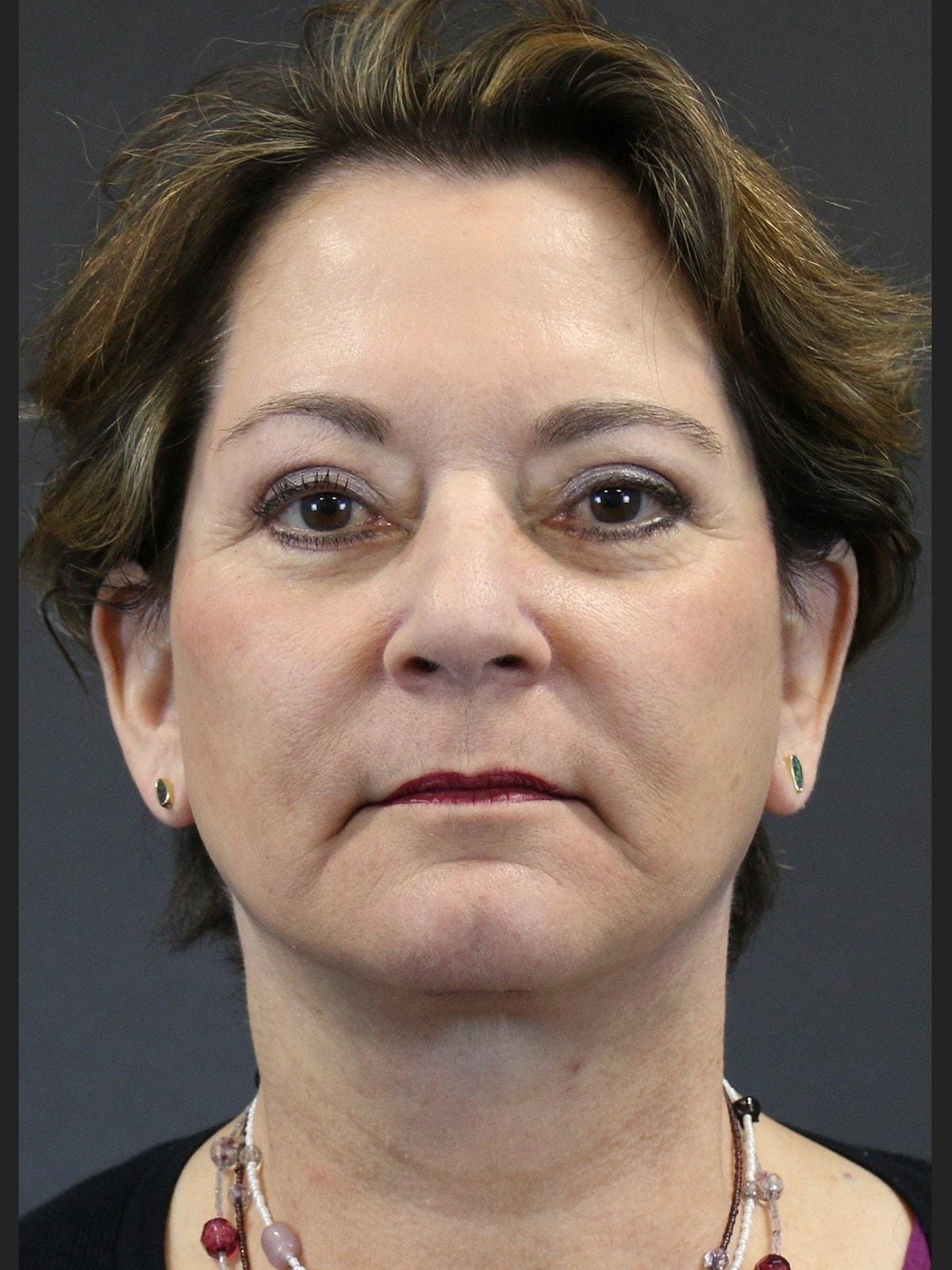 FaceLove Facial Plastic Surgery facelift after — Oakbrook Terrace, IL