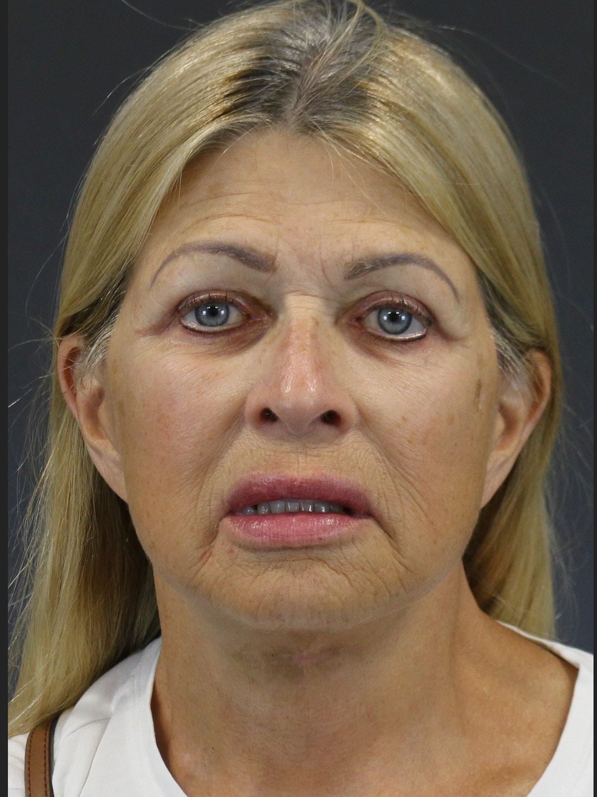 FaceLove Facial Plastic Surgery eyelid lift after — Oakbrook Terrace, IL