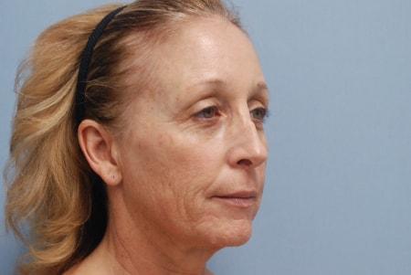 Facelift before at Robert Kearney, MD, FACS in San Diego, CA