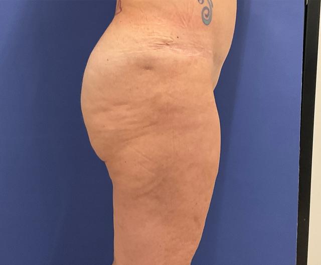 Brazilian Butt Lift after at Robert Kearney, MD, FACS in San Diego, CA