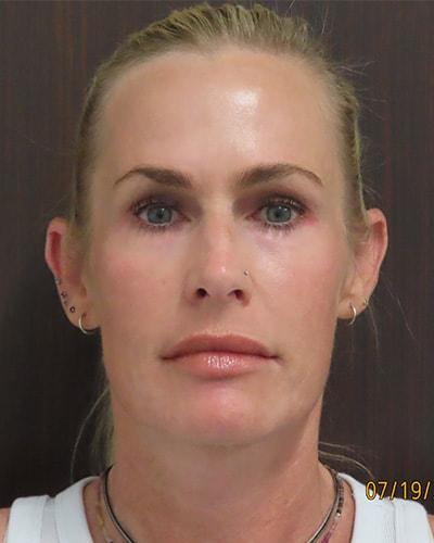 Chemical Peel after at Robert Kearney, MD, FACS in San Diego, CA
