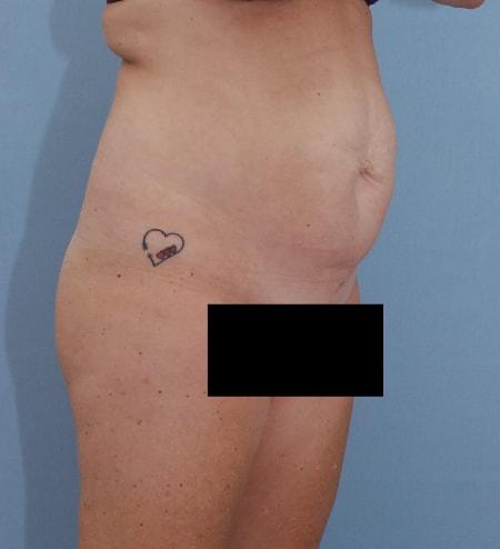 Mini Tummy Tuck before at Robert Kearney, MD, FACS in San Diego, CA