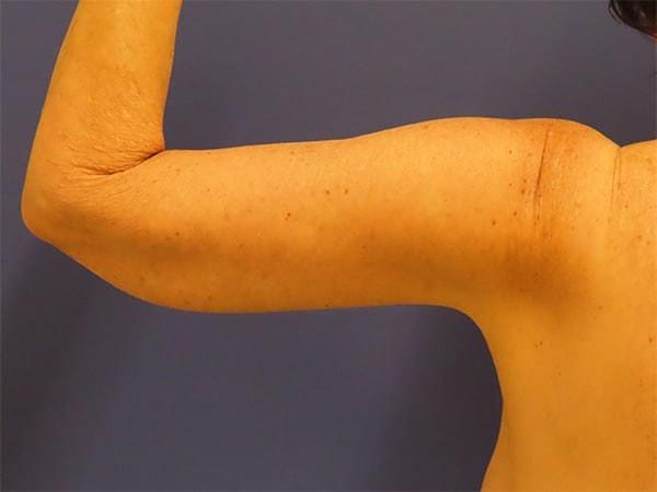 Arm Lift after at Robert Kearney, MD, FACS in San Diego, CA