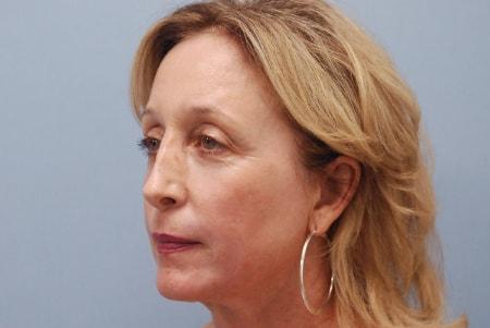 Robert Kearney, MD, FACS chemical peel after — San Diego, CA