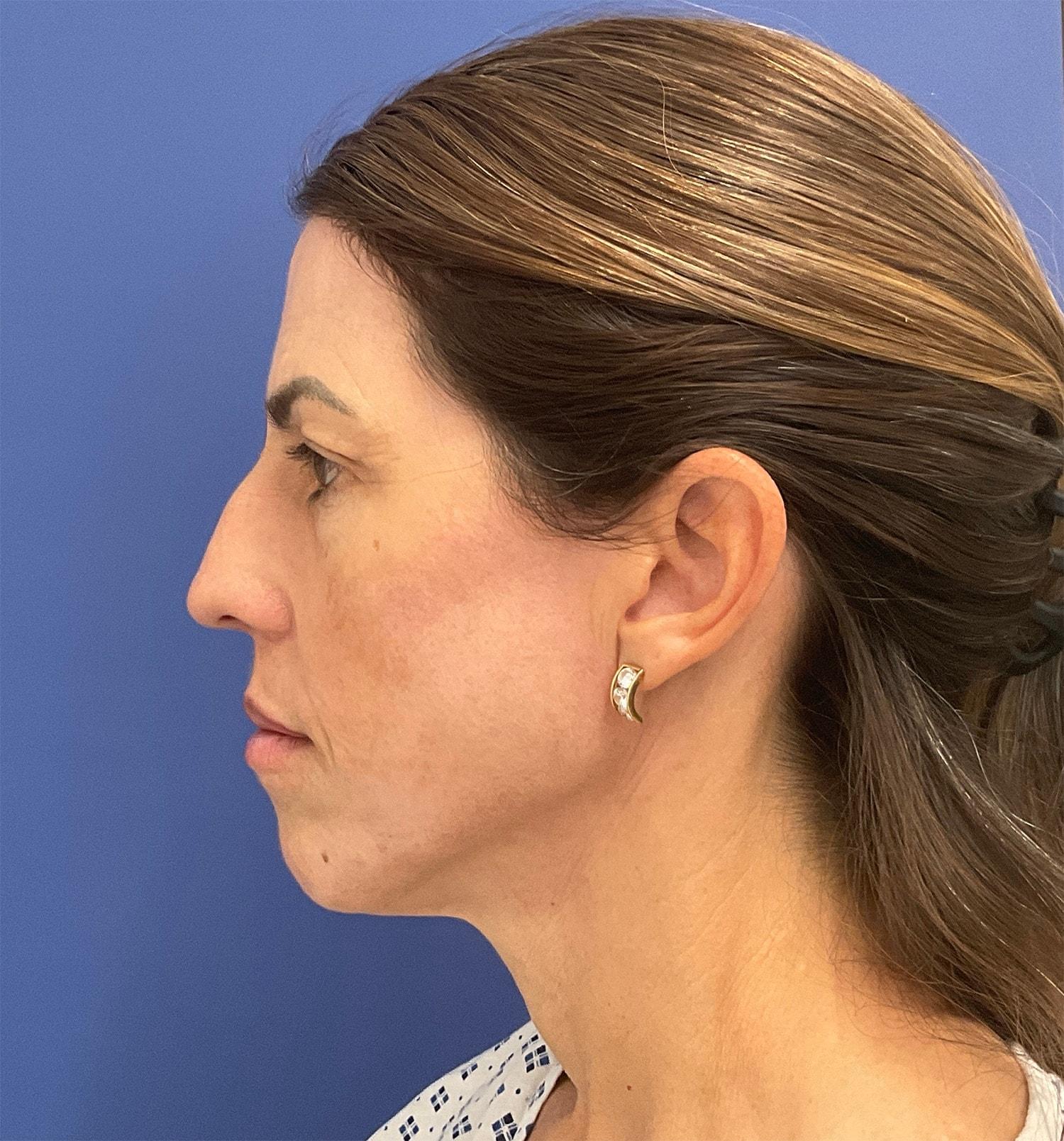 Robert Kearney, MD, FACS chemical peel after — San Diego, CA