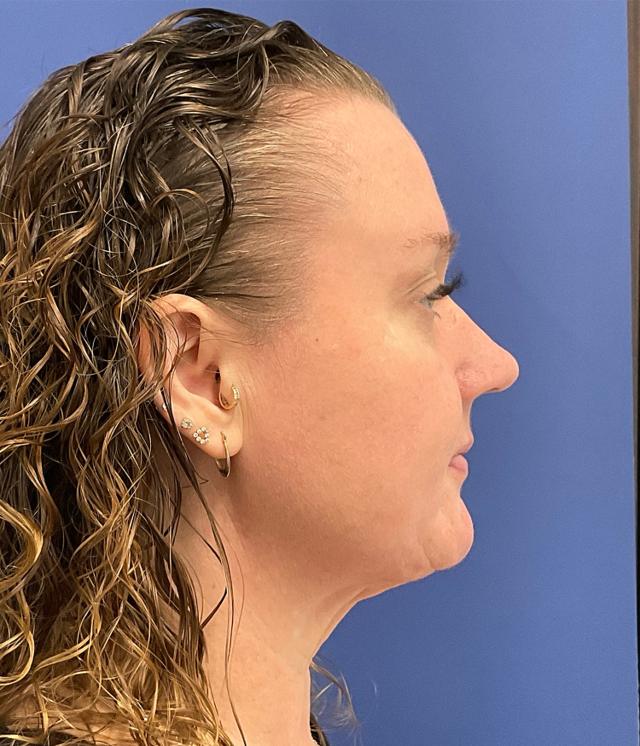 Neck Liposuction after at Robert Kearney, MD, FACS in San Diego, CA