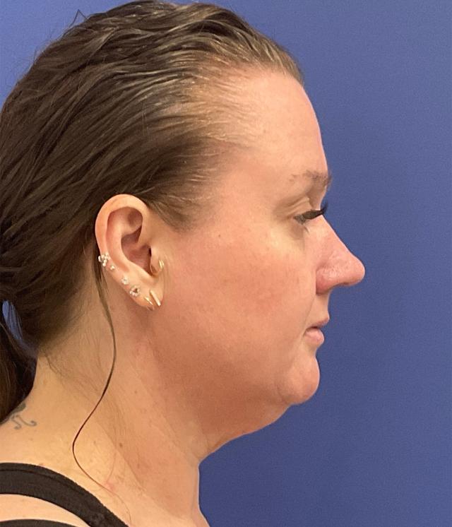 Neck Liposuction before at Robert Kearney, MD, FACS in San Diego, CA