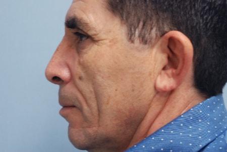 Functional Rhinoplasty after at Robert Kearney, MD, FACS in San Diego, CA