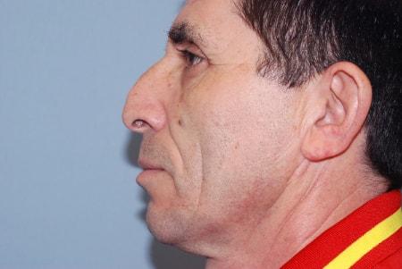 Functional Rhinoplasty before at Robert Kearney, MD, FACS in San Diego, CA