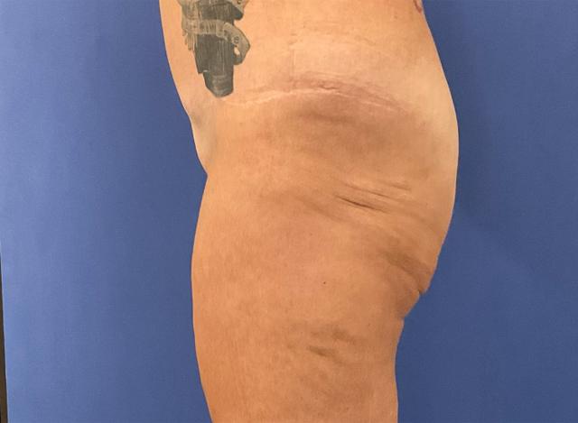 Brazilian Butt Lift before at Robert Kearney, MD, FACS in San Diego, CA