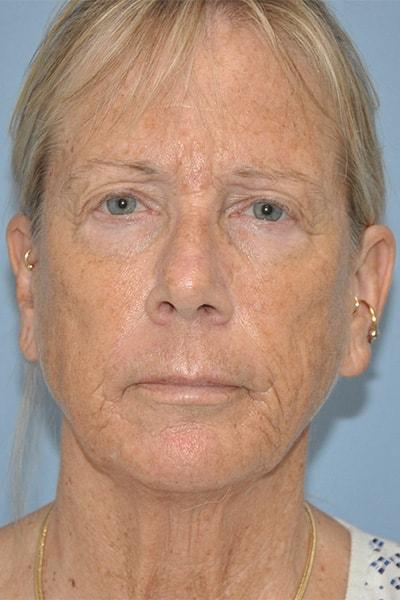 Chemical Peel before at Robert Kearney, MD, FACS in San Diego, CA