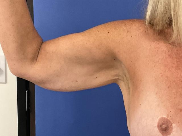 Arm Lift before at Robert Kearney, MD, FACS in San Diego, CA