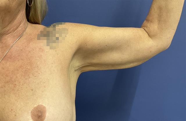 Liposuction after at Robert Kearney, MD, FACS in San Diego, CA