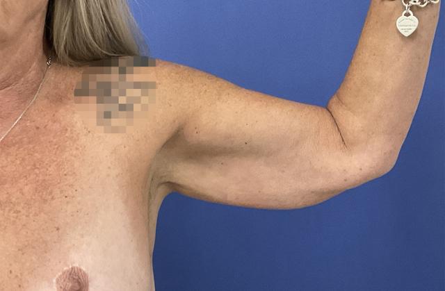 Liposuction before at Robert Kearney, MD, FACS in San Diego, CA