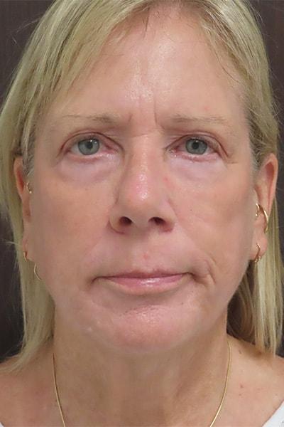 Chemical Peel after at Robert Kearney, MD, FACS in San Diego, CA