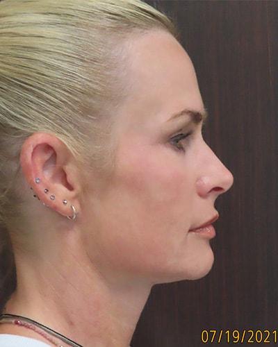 Chemical Peel after at Robert Kearney, MD, FACS in San Diego, CA