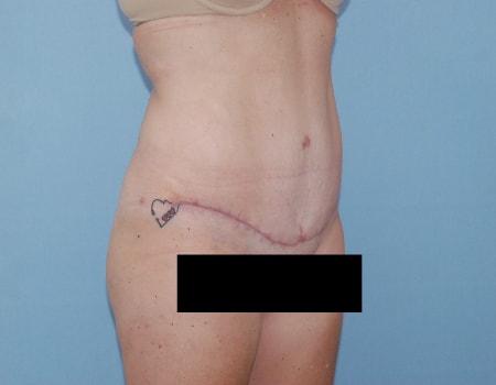 Robert Kearney, MD, FACS tummy tuck after — San Diego, CA