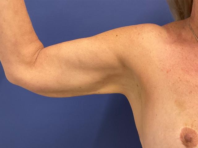 Arm Lift after at Robert Kearney, MD, FACS in San Diego, CA