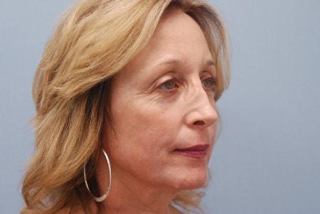 Facelift after at Robert Kearney, MD, FACS in San Diego, CA