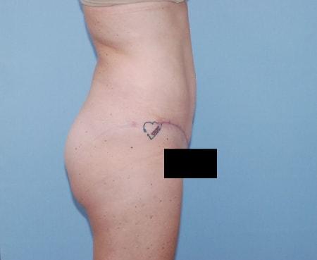 Robert Kearney, MD, FACS tummy tuck after — San Diego, CA