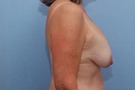 Breast Lift before at Robert Kearney, MD, FACS in San Diego, CA