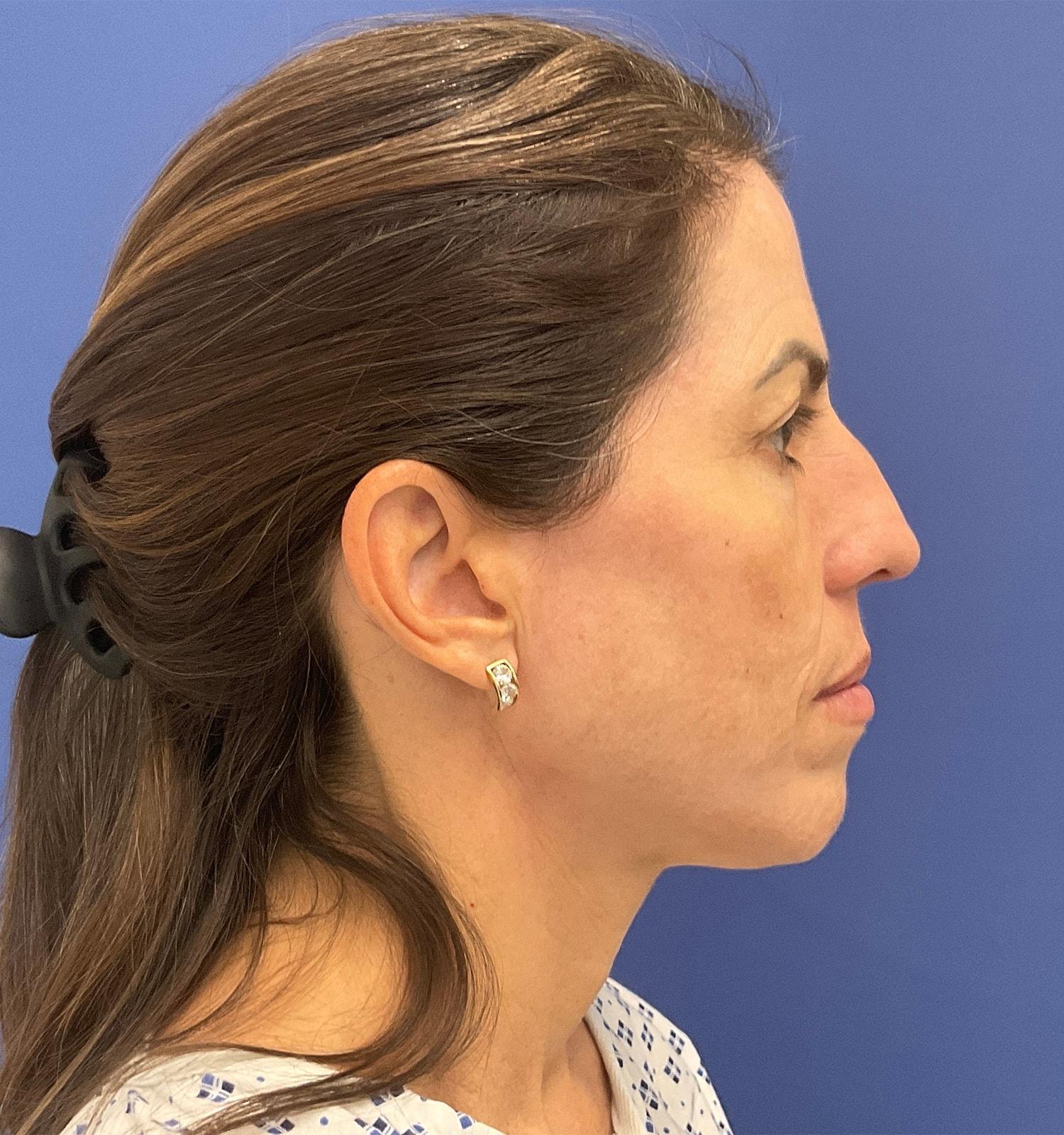 Robert Kearney, MD, FACS chemical peel after — San Diego, CA