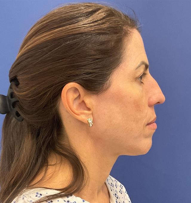 Chemical Peel after at Robert Kearney, MD, FACS in San Diego, CA