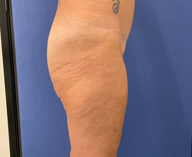 Brazilian Butt Lift before at Robert Kearney, MD, FACS in San Diego, CA