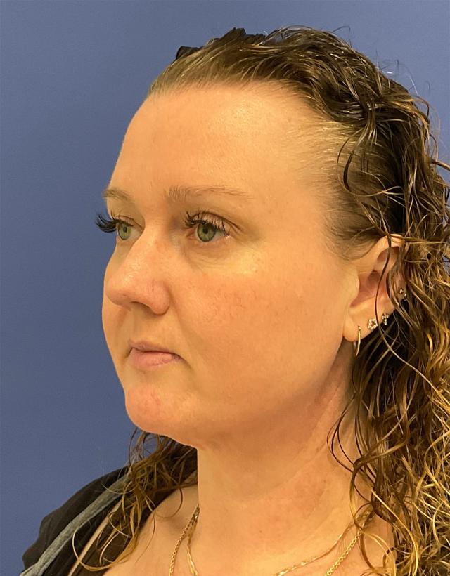 Neck Liposuction after at Robert Kearney, MD, FACS in San Diego, CA